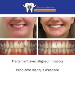 orthodontie-adulte-probleme-correction-crossbite